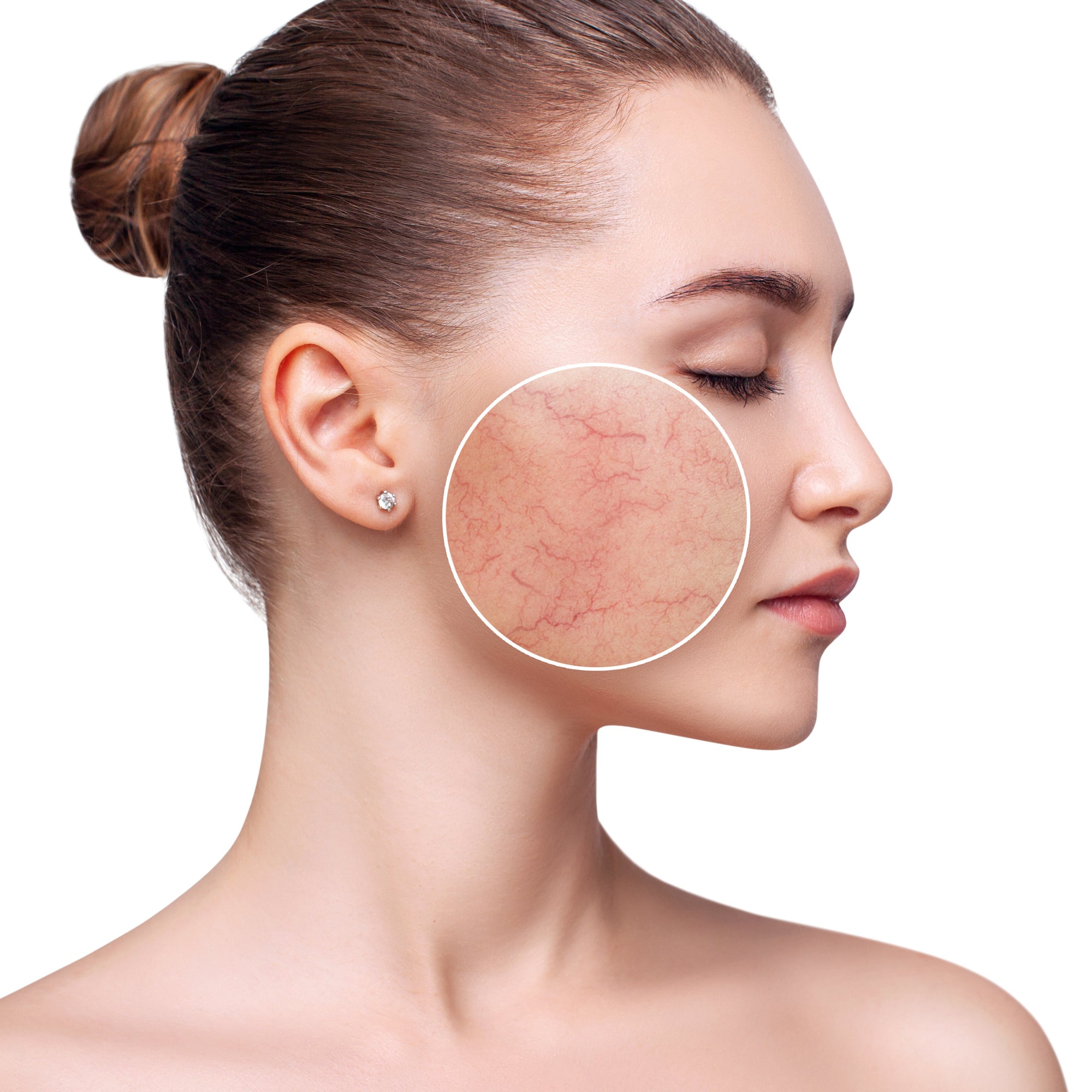 Rosacea im Griff: Natürliche Hautpflege mit Naturkosmetik - Der ultimative Ratgeber für gesunde Haut